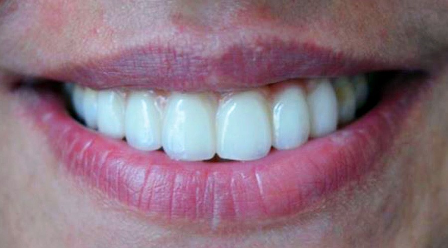 قبل تركيبات-اسنان